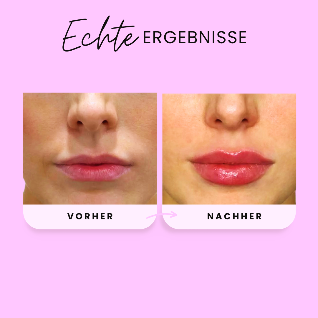 Plumpé™ | Volle & definierte Lippen in Minuten
