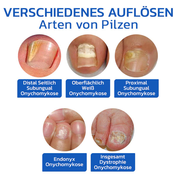 OrthoVital Mini gegen Nagelpilz
