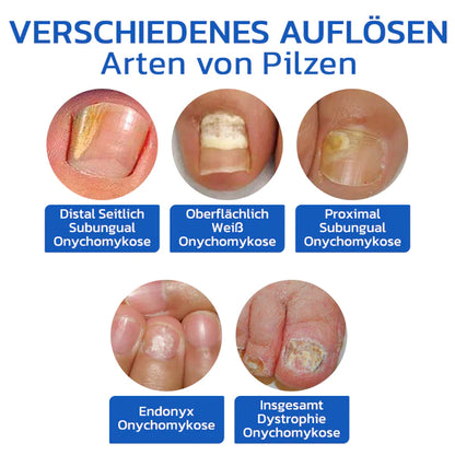 OrthoVital Mini gegen Nagelpilz