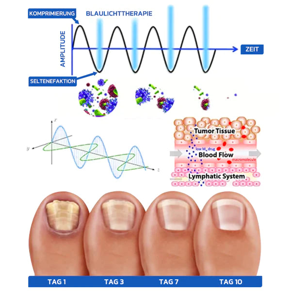 OrthoVital Mini gegen Nagelpilz