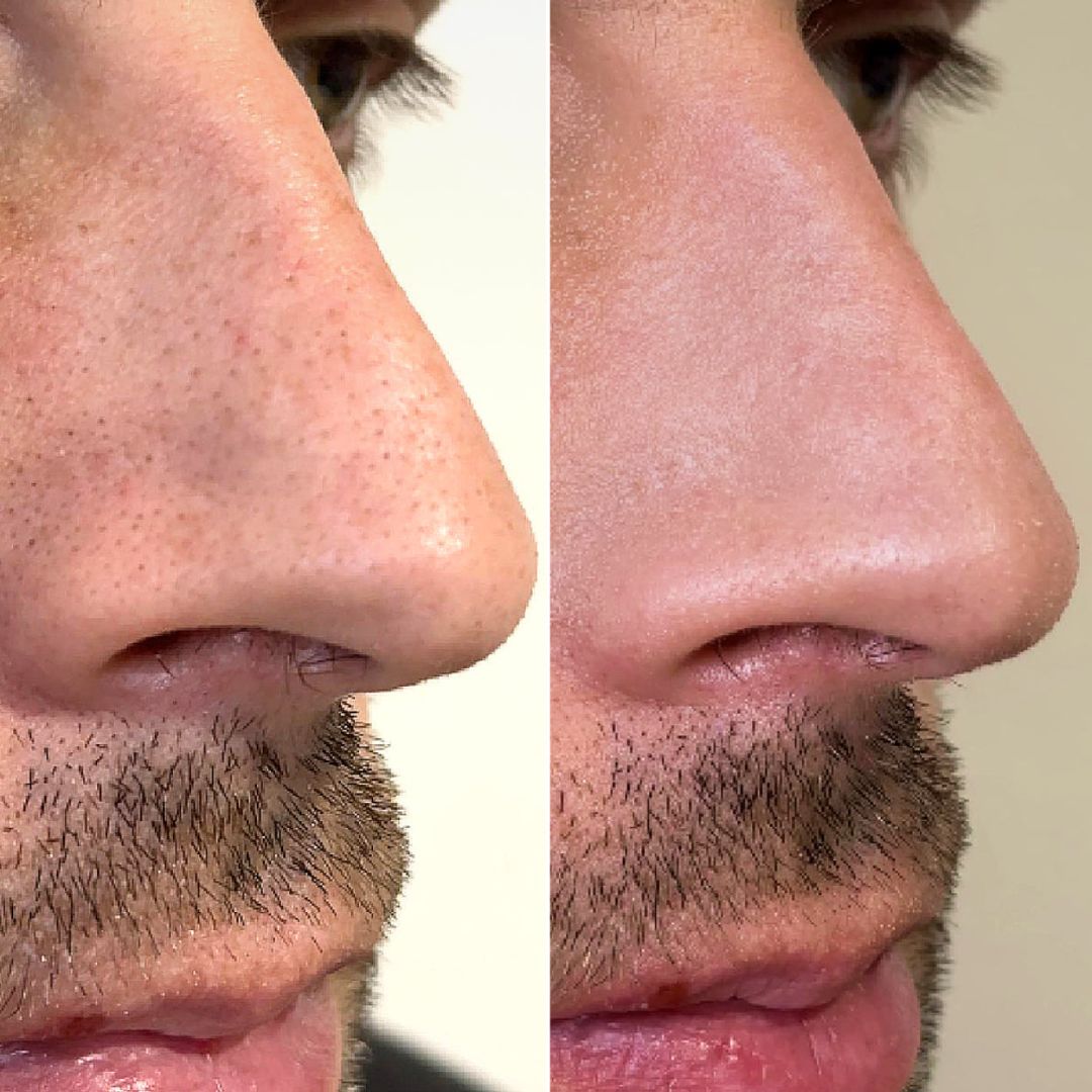 Nose Strips mit Hydrokolloid: Wie du Mitesser ganz schnell loswirst