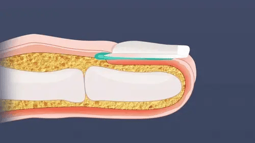 OrthoVital Mini gegen Nagelpilz
