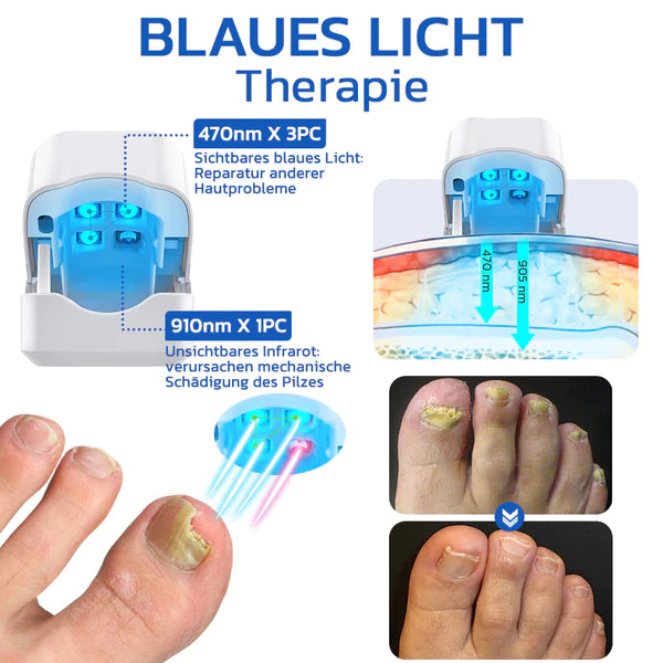 OrthoVital Mini gegen Nagelpilz