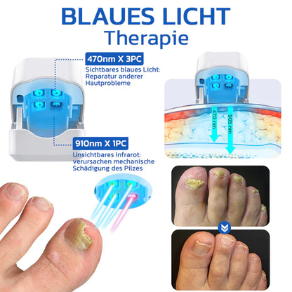 OrthoVital Mini gegen Nagelpilz
