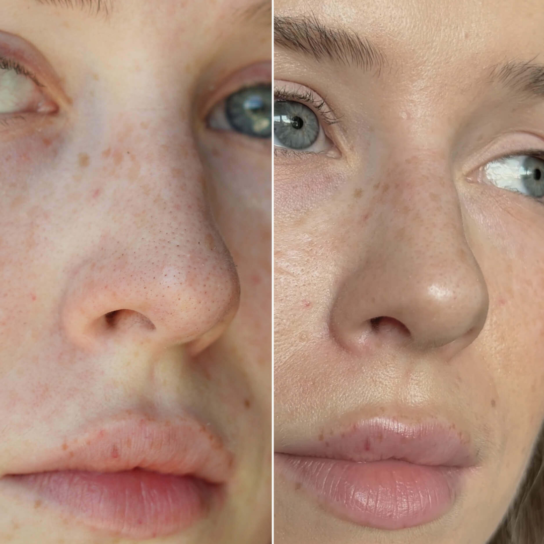 Nose Strips mit Hydrokolloid: Wie du Mitesser ganz schnell loswirst