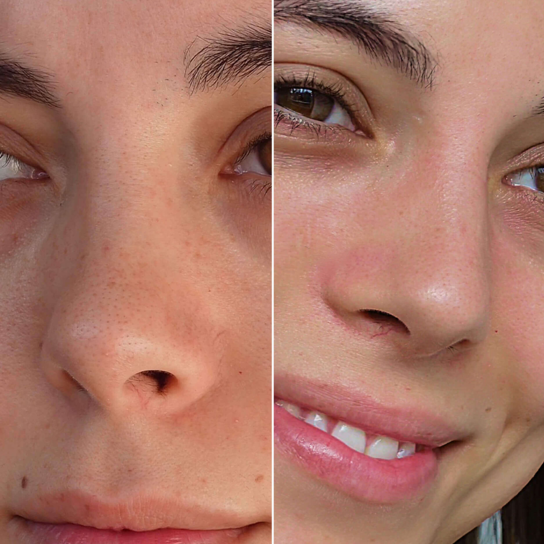 Nose Strips mit Hydrokolloid: Wie du Mitesser ganz schnell loswirst