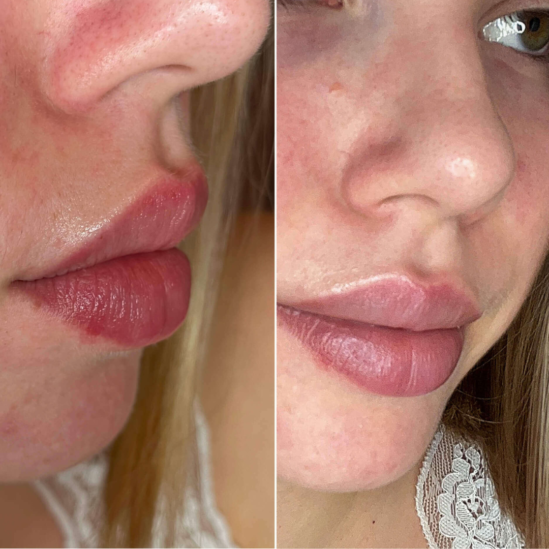 Nose Strips mit Hydrokolloid: Wie du Mitesser ganz schnell loswirst